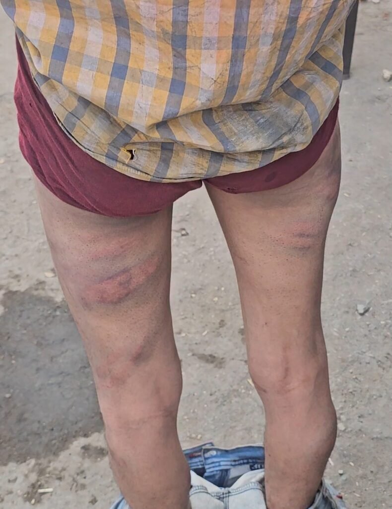 निगाही परियोजना में प्राइवेट सिक्योरिटी की बर्बरता, बकरी चरा रहे व्यक्ति को चोरी के शक में पीटकर अधमरा छोड़ा