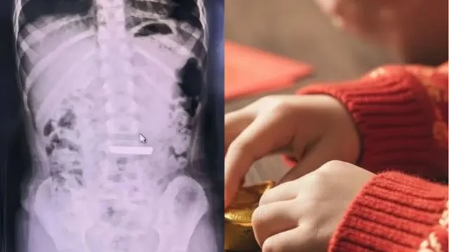 चीन में खेल-खेल में 50 ग्राम सोने का बिस्किट निगल गई 5 साल की बच्ची, सर्जरी के बाद बची जान